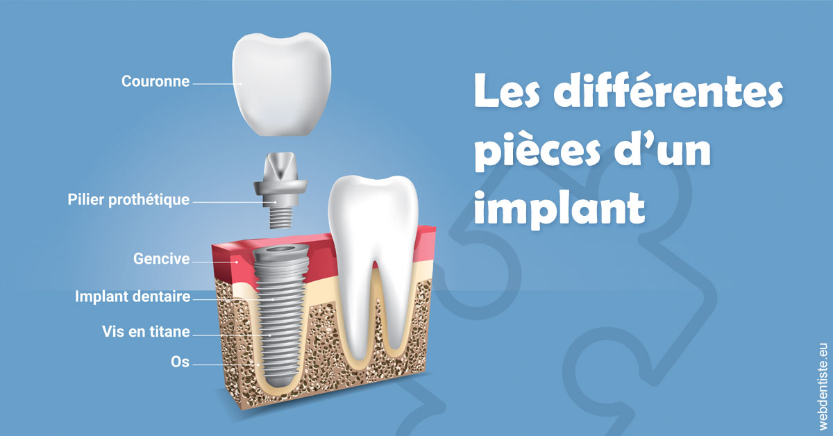 https://www.docteur-nooshika.fr/Les différentes pièces d’un implant 1